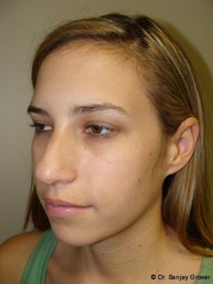 Chin Augmentation Before and After 04 | Grover Aesthetics