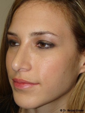 Chin Augmentation Before and After 04 | Grover Aesthetics