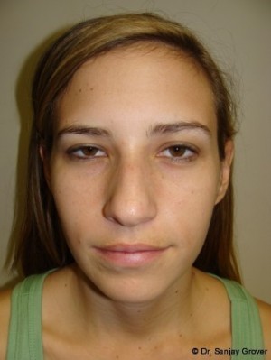 Chin Augmentation Before and After 04 | Grover Aesthetics
