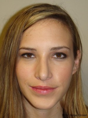 Chin Augmentation Before and After 04 | Grover Aesthetics