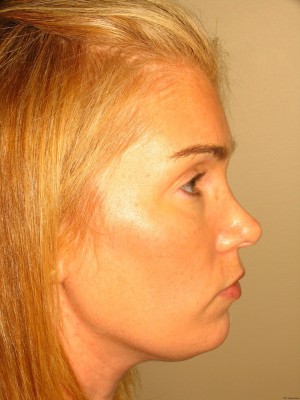 Chin Augmentation Before and After | Grover Aesthetics