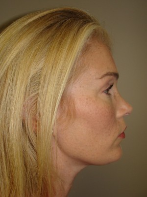 Chin Augmentation Before and After | Grover Aesthetics