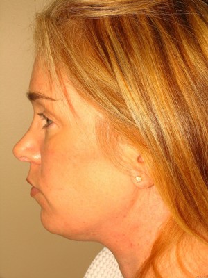 Chin Augmentation Before and After 05 | Grover Aesthetics