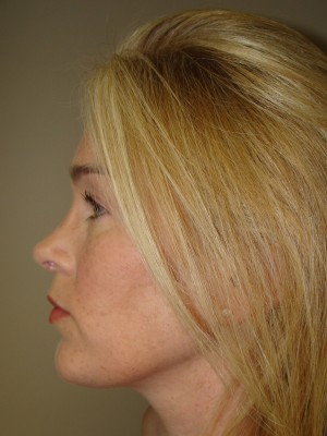 Chin Augmentation Before and After 05 | Grover Aesthetics