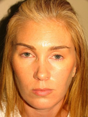Chin Augmentation Before and After 05 | Grover Aesthetics