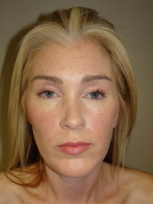 Chin Augmentation Before and After 05 | Grover Aesthetics
