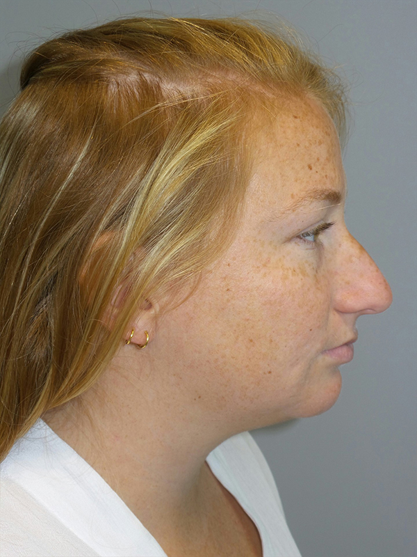 Chin Augmentation Before and After 01 | Sanjay Grover MD FACS