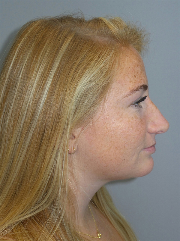 Chin Augmentation Before and After | Sanjay Grover MD FACS