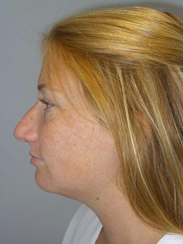 Chin Augmentation Before and After 06 | Sanjay Grover MD FACS