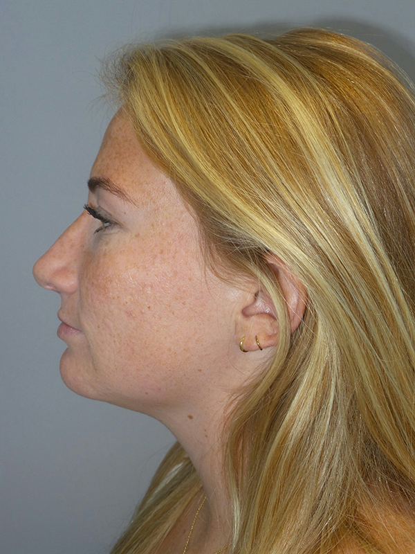Chin Augmentation Before and After 06 | Sanjay Grover MD FACS