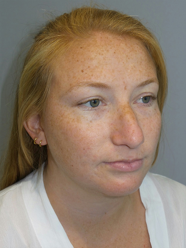 Chin Augmentation Before and After 06 | Grover Aesthetics