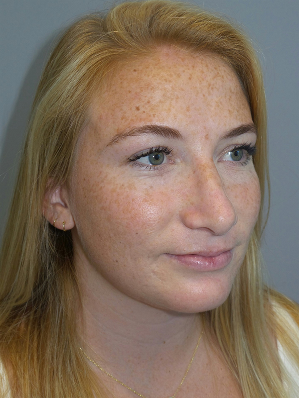 Chin Augmentation Before and After 06 | Grover Aesthetics