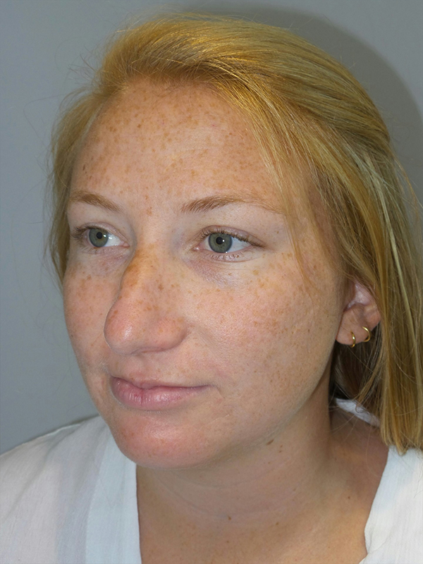 Chin Augmentation Before and After 06 | Grover Aesthetics