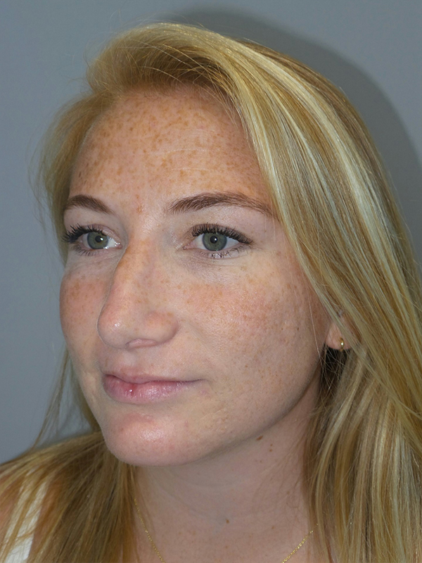 Chin Augmentation Before and After 06 | Grover Aesthetics