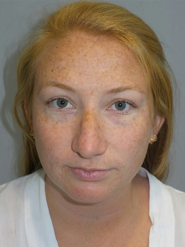 Chin Augmentation Before and After 06 | Grover Aesthetics
