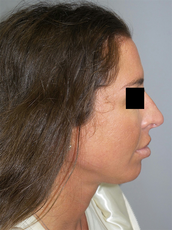 Chin Augmentation Before and After 07 | Sanjay Grover MD FACS