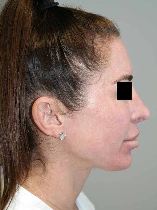 Chin Augmentation Before and After | Grover Aesthetics