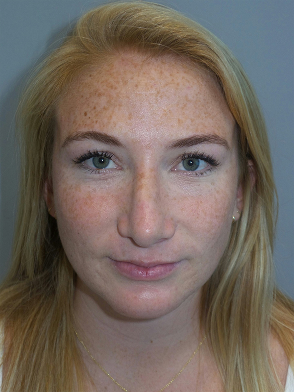 Ellevate Neck Suture Suspension Before and After | Grover Aesthetics
