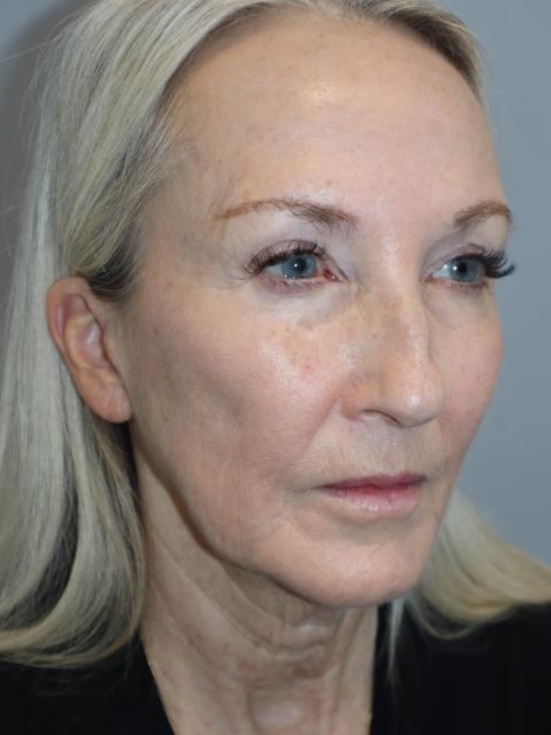 Facelift Before and After 26 | Sanjay Grover MD FACS