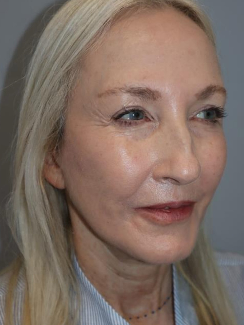 Facelift Before and After | Grover Aesthetics