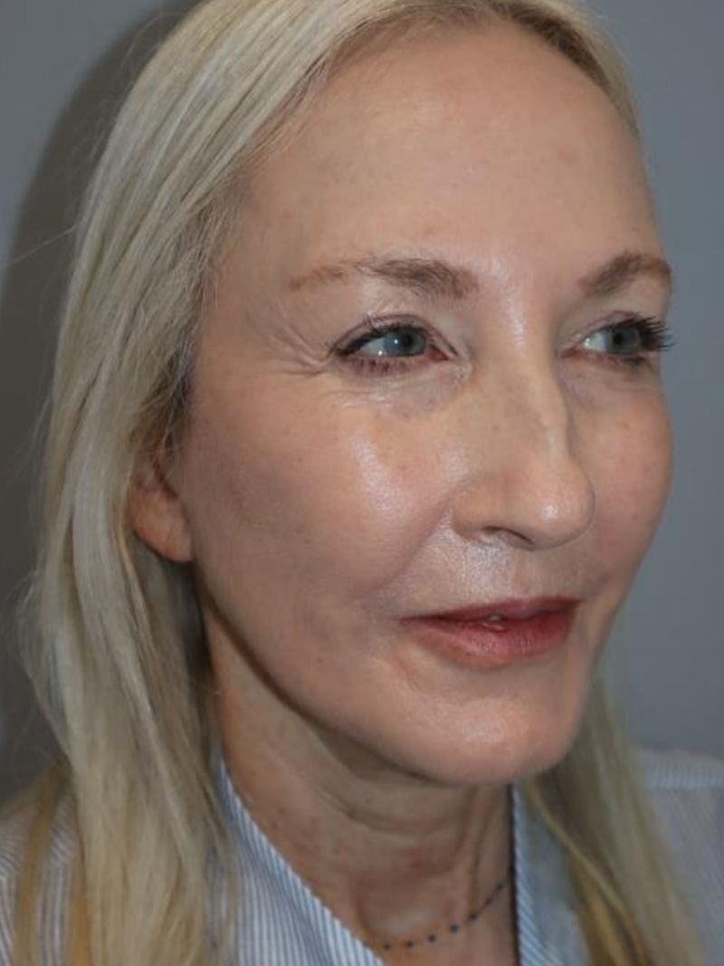 Facelift Before and After | Sanjay Grover MD FACS