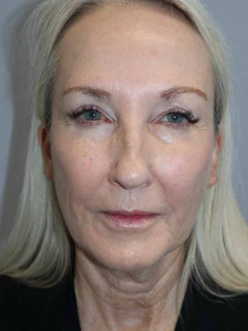 Facelift Before and After 01 | Sanjay Grover MD FACS