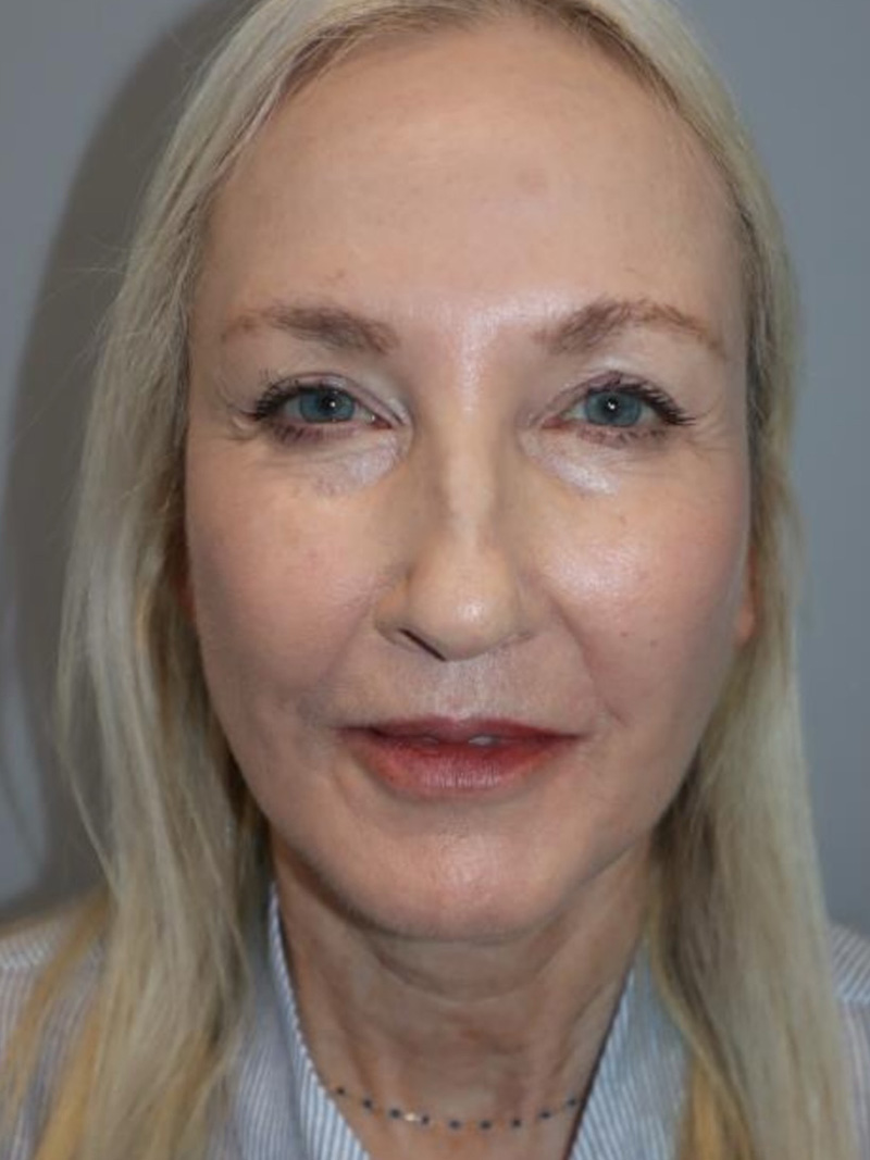 Facelift Before and After 01 | Sanjay Grover MD FACS