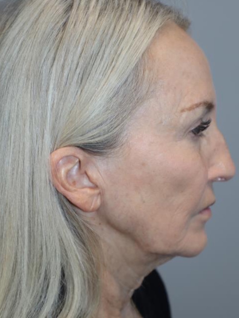 Facelift Before and After 01 | Sanjay Grover MD FACS