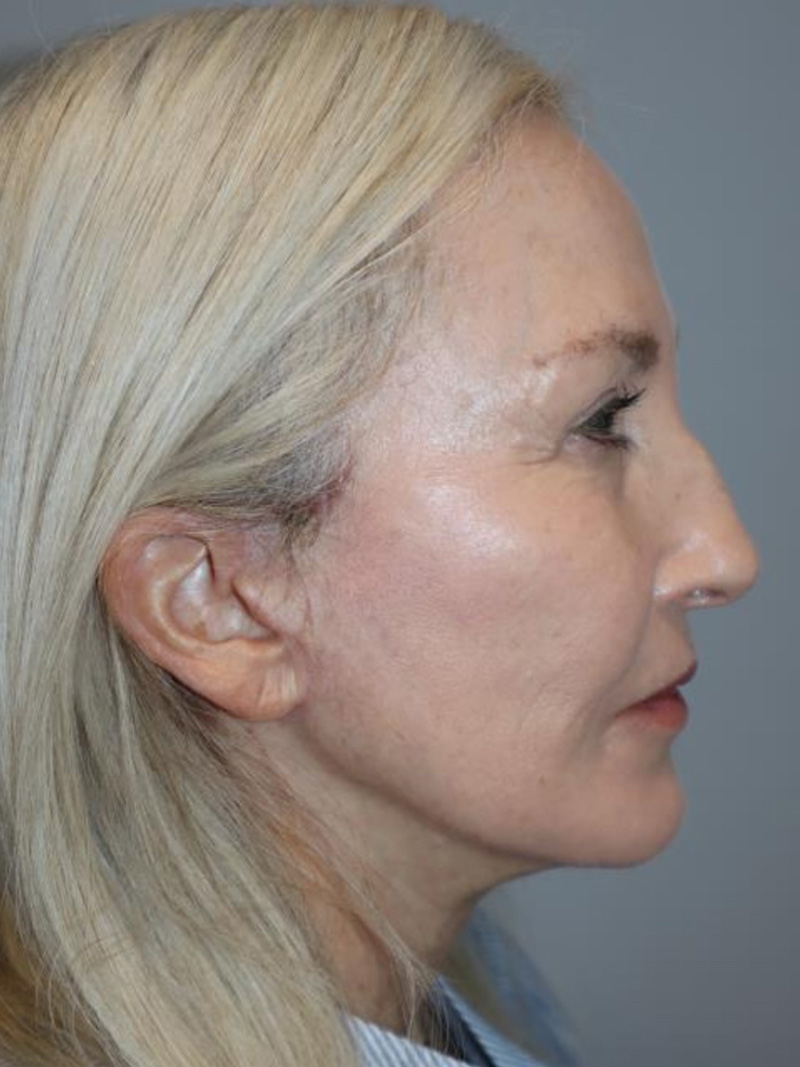 Facelift Before and After 01 | Sanjay Grover MD FACS