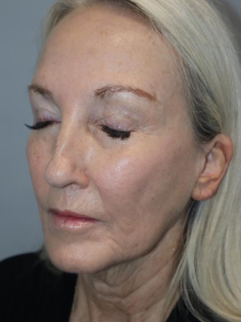 Facelift Before and After 01 | Sanjay Grover MD FACS