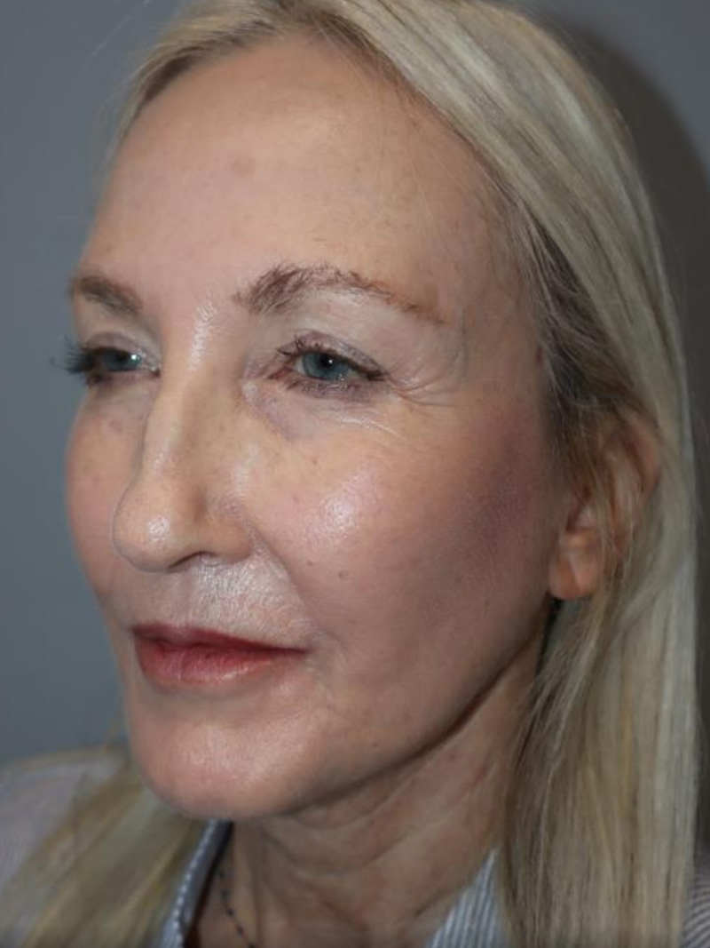 Facelift Before and After 01 | Sanjay Grover MD FACS