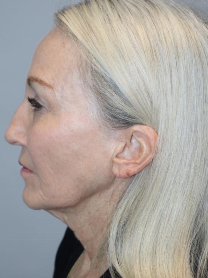 Facelift Before and After 01 | Sanjay Grover MD FACS