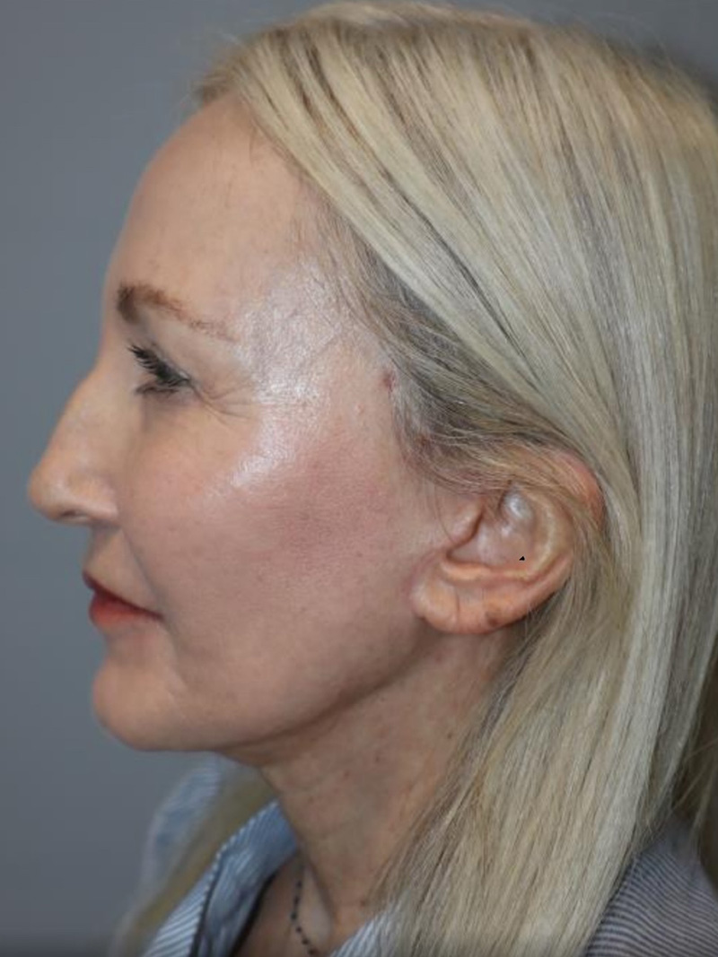 Facelift Before and After 01 | Sanjay Grover MD FACS