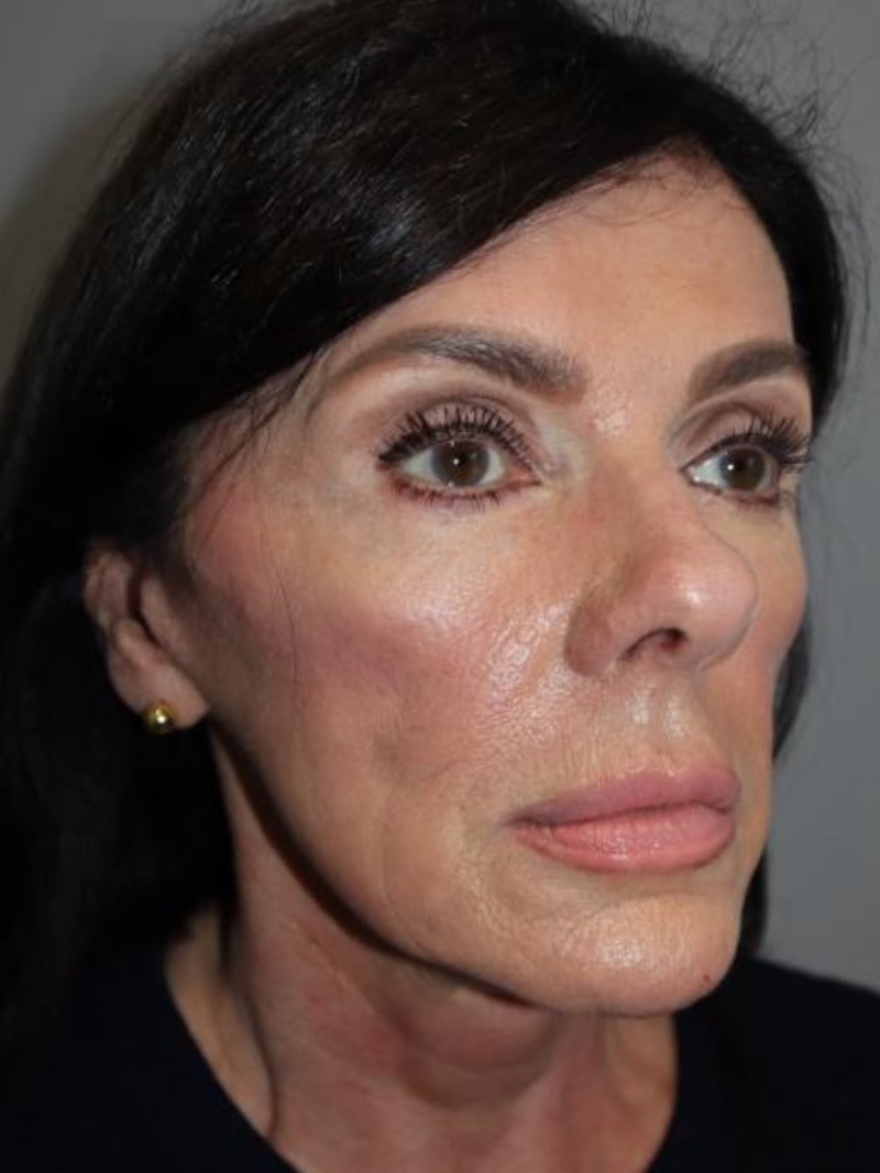 Facelift Before and After 29 | Sanjay Grover MD FACS