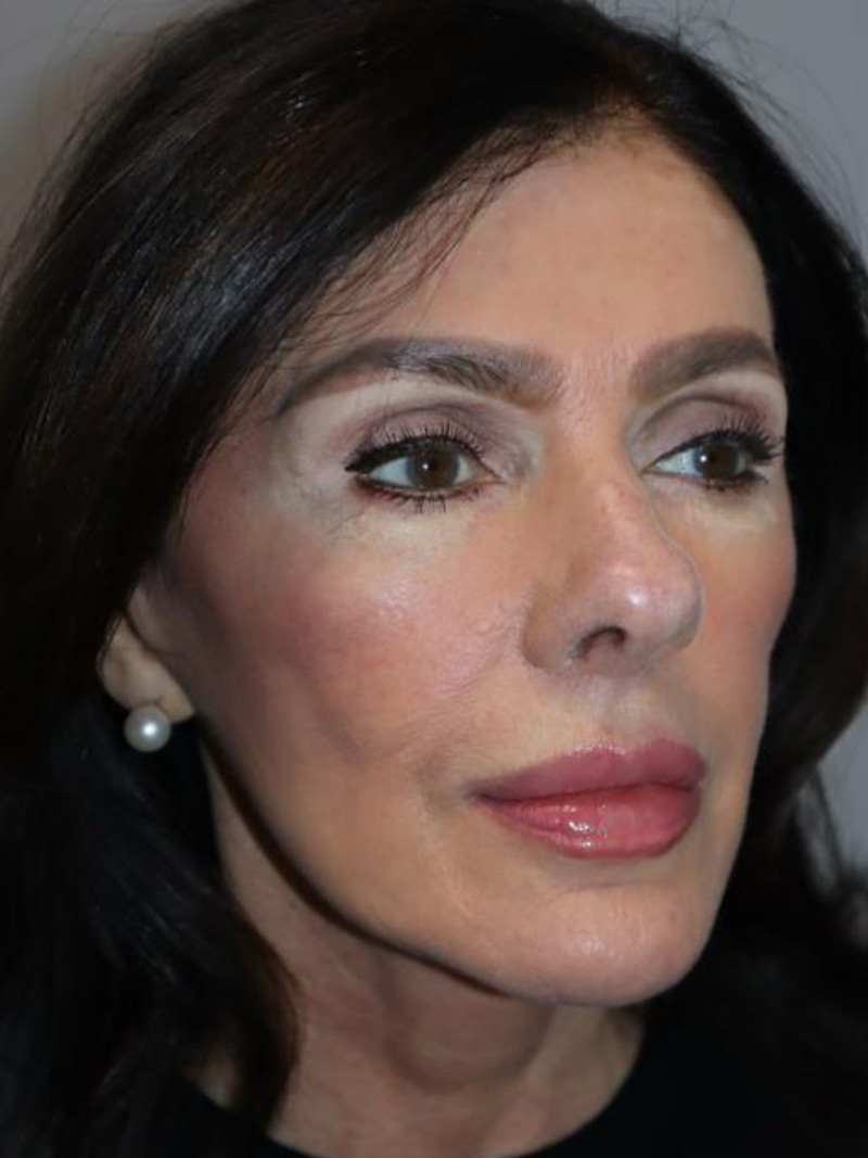 Facelift Before and After | Grover Aesthetics