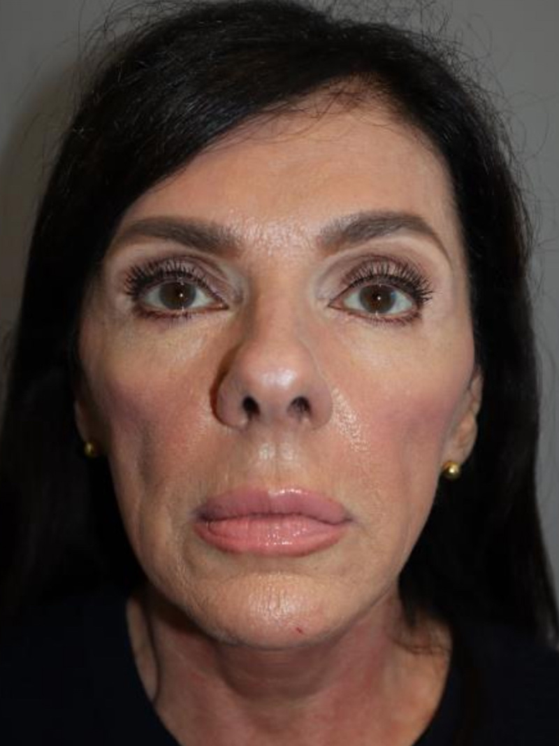 Facelift Before and After 02 | Sanjay Grover MD FACS