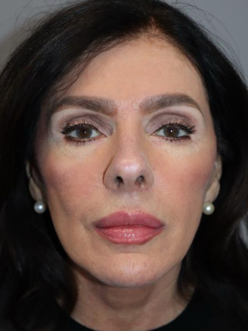 Facelift Before and After 02 | Sanjay Grover MD FACS