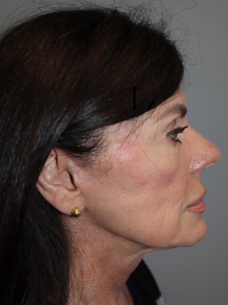 Facelift Before and After 02 | Sanjay Grover MD FACS