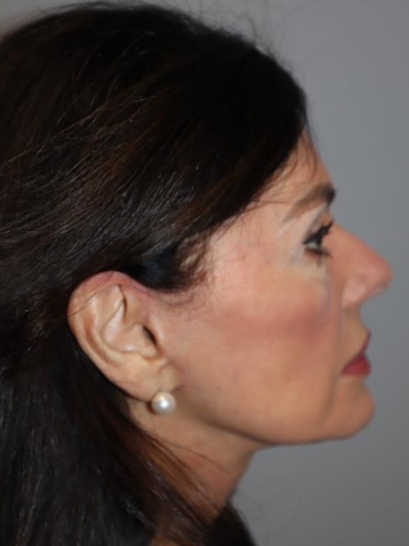 Facelift Before and After 02 | Sanjay Grover MD FACS