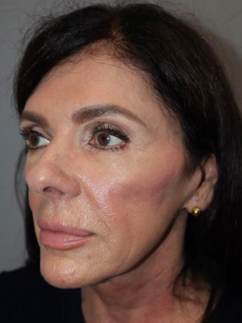 Facelift Before and After 02 | Sanjay Grover MD FACS