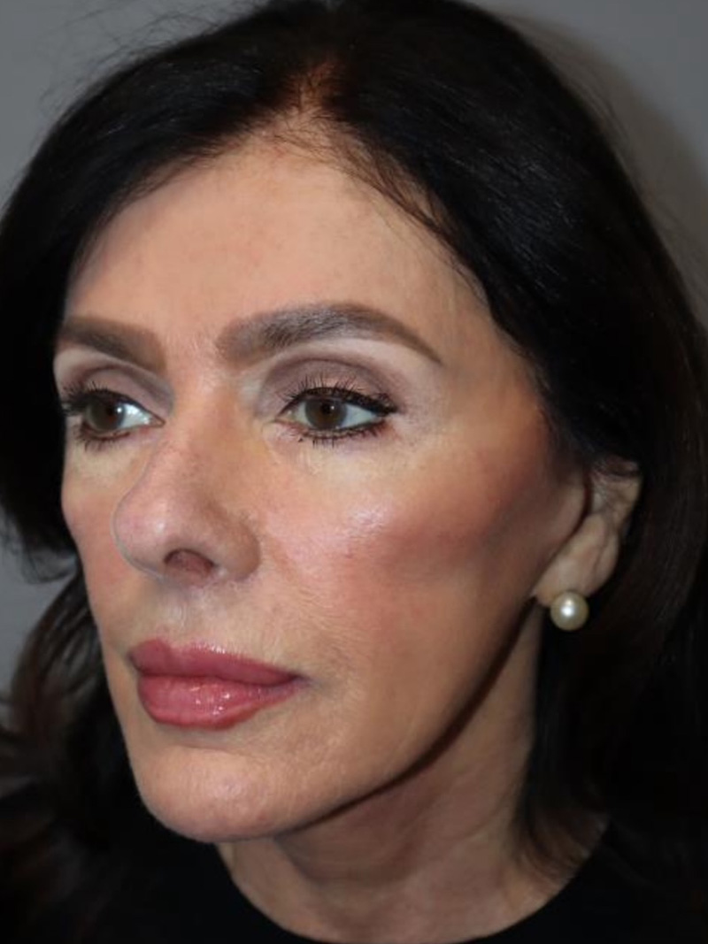Facelift Before and After 02 | Grover Aesthetics