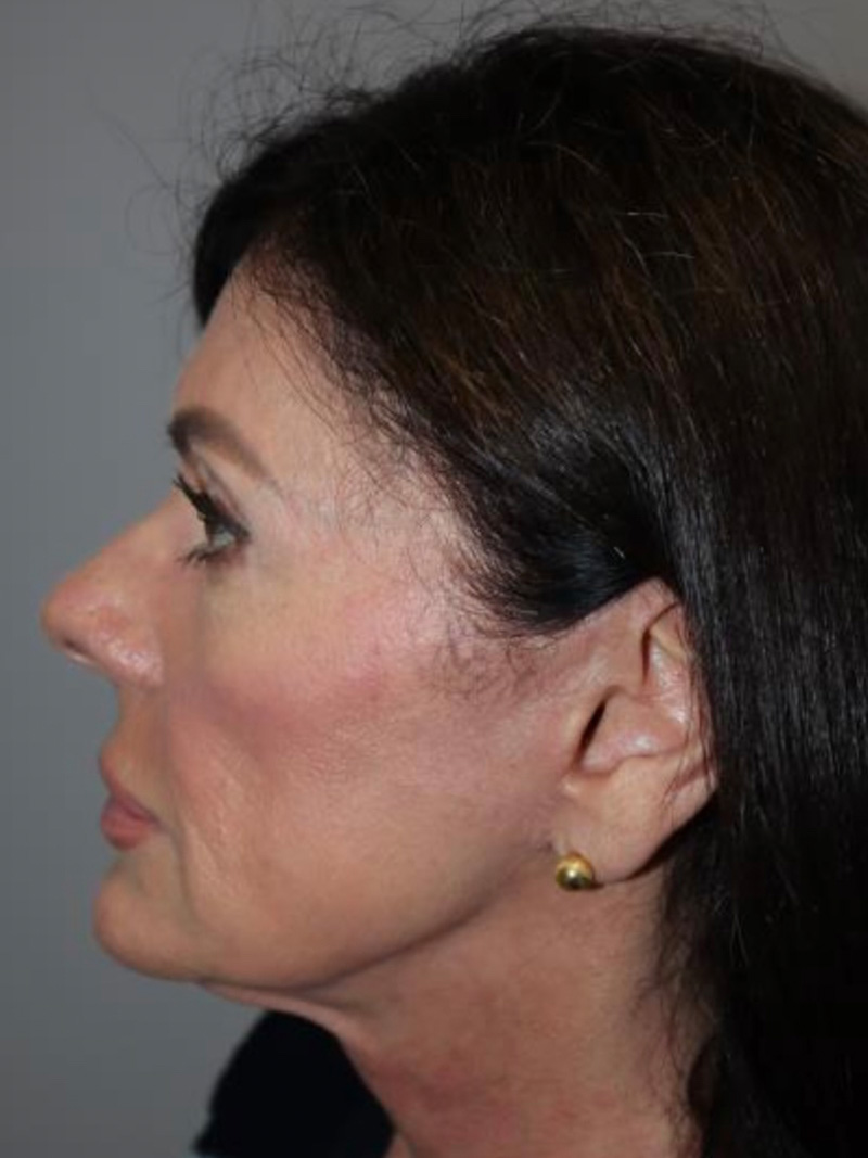 Facelift Before and After 02 | Sanjay Grover MD FACS