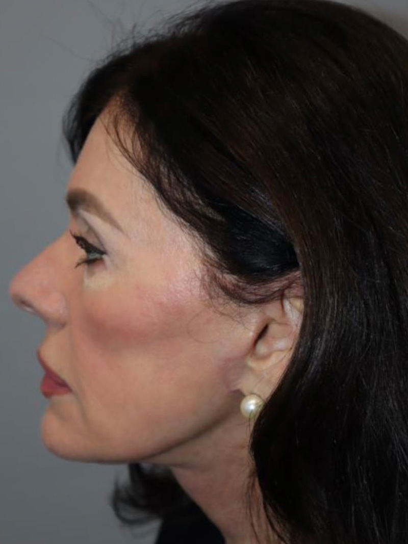 Facelift Before and After 02 | Sanjay Grover MD FACS