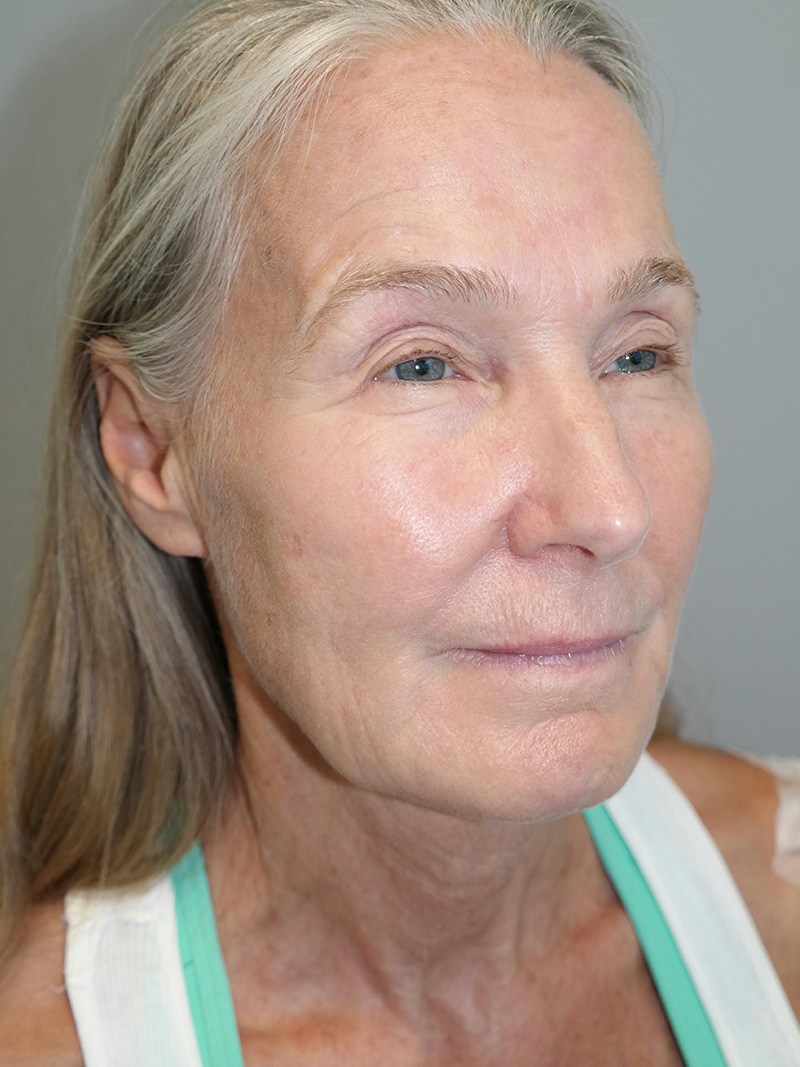 Facelift Before and After 06 | Sanjay Grover MD FACS
