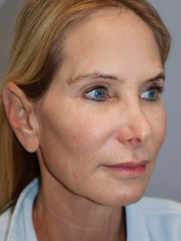 Facelift Before and After 28 | Sanjay Grover MD FACS