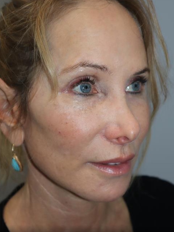 Facelift Before and After | Grover Aesthetics