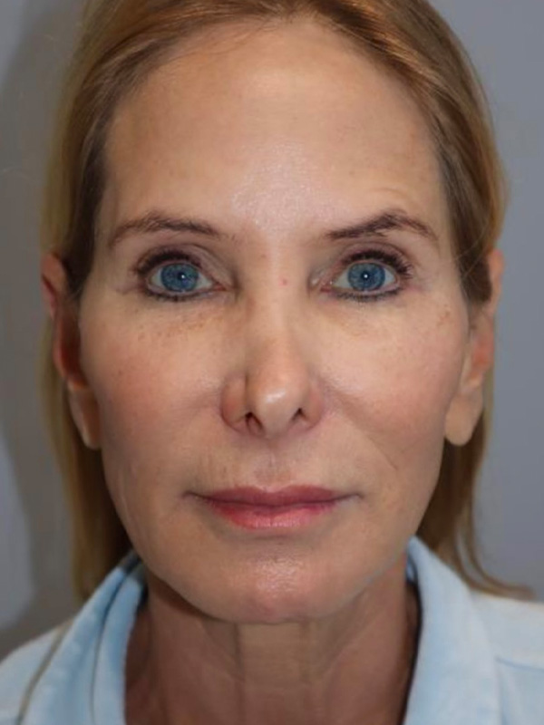 Facelift Before and After 03 | Sanjay Grover MD FACS