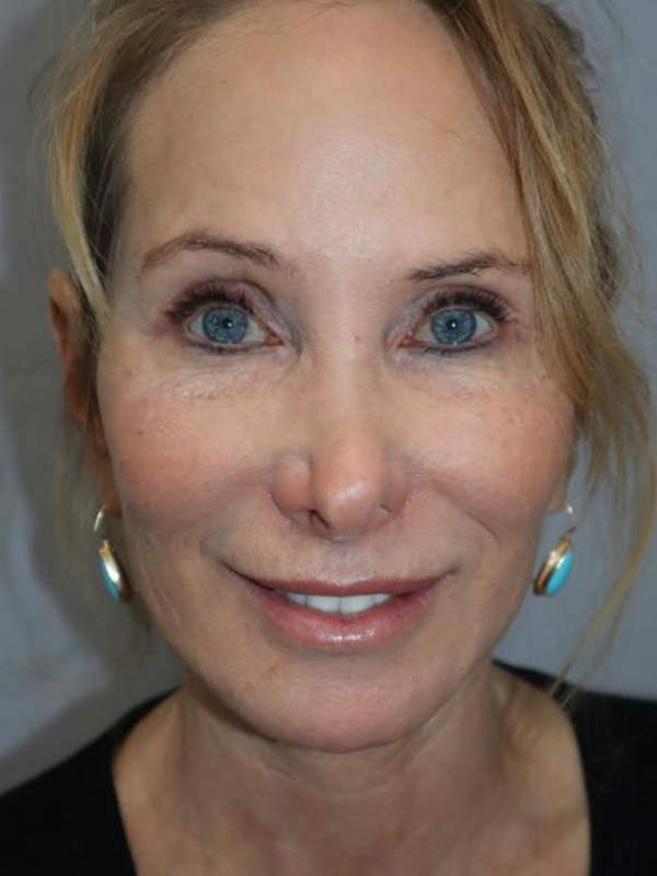 Facelift Before and After 03 | Sanjay Grover MD FACS