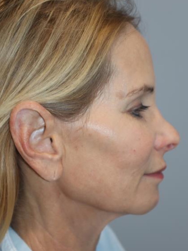 Facelift Before and After 03 | Sanjay Grover MD FACS