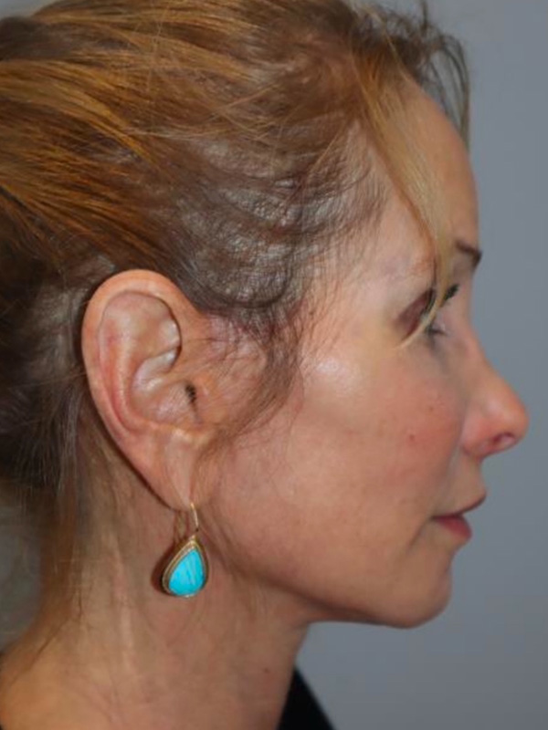 Facelift Before and After 03 | Sanjay Grover MD FACS